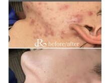 エミー(emy)/江坂/毛穴/ハーブピーリング