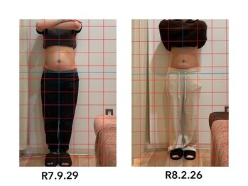 よしの鍼灸整骨院/産後骨盤矯正　　28歳　20回