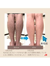 ケステ(Keste)/セルフ脱毛