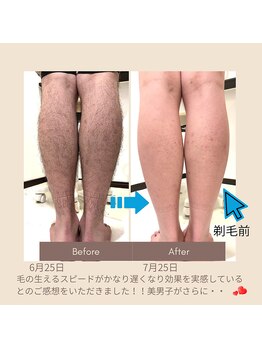 ケステ(Keste)/セルフ脱毛
