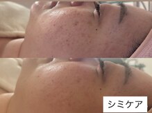 サロン ドロップ 上小田井(Salon drop)/「シミ改善」途中経過