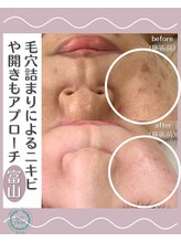 サロン リュンヌ(salon lune)/エクストラクション＋ピーリング