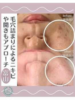 サロン リュンヌ(salon lune)/エクストラクション+ピーリング