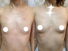 ハレオラ(HaleOla)/『Aカップも無いです』とお悩み