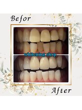 ホワイトニングショップ 宇都宮店/Before&After美白ホワイトニング