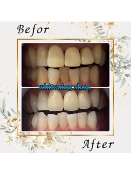 ホワイトニングショップ 宇都宮店/Before&After美白ホワイトニング