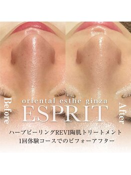 エスプリ 銀座店/ハーブピーリング銀座