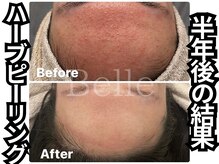 ベル 心斎橋店(Belle)/ハーブピーリング