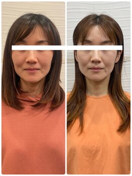 長寿鍼灸院 長寿整骨院/美容鍼100本の効果★小顔効果