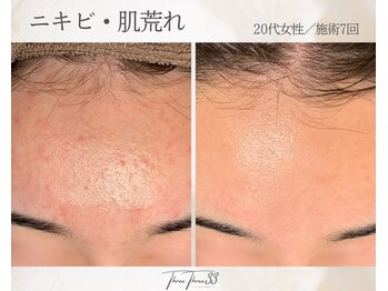 スリースリー(THREE THREE)/ニキビ・肌荒れ