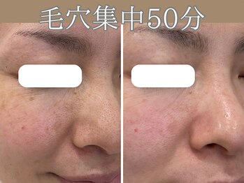 ハウオリ(HAUOLI)/毛穴集中50分