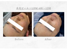 エヴァーグレース 三河安城店(EVER GRACE)/【肌管理】水光ピール＋LDM