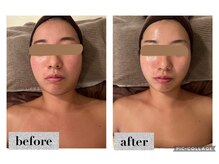 マンダ 田町(Manda)/頬のたるみをリフトして引き上げ