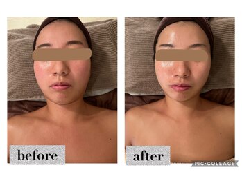 マンダ 田町(Manda)/頬のたるみをリフトして引き上げ