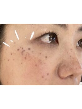 シミしわ改善！予防ケア