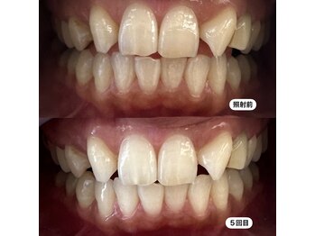 クレン(CLEN)/医療提携ホワイトニング