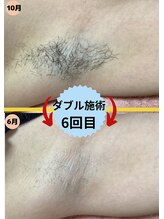 ディスイズミー シュガーリング(This is me Sugaring)/【ダブル】美容脱毛併用で効果◎