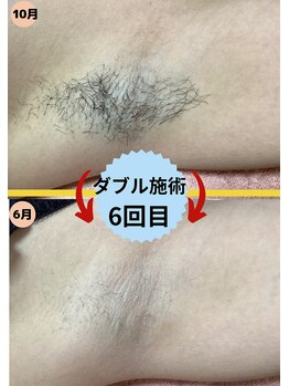 ディスイズミー シュガーリング(This is me Sugaring)/【ダブル】美容脱毛併用で効果◎