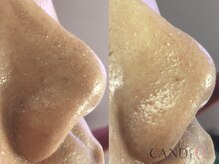 キャンディ 難波心斎橋店(CANDi)/ハイドラピーリング/黒ずみ毛穴