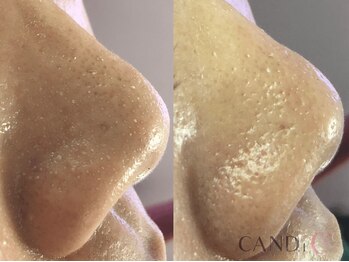 キャンディ 難波心斎橋店(CANDi)/ハイドラピーリング/黒ずみ毛穴