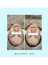 ココポキ 岐阜店/水光フェイシャル