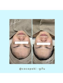 ココポキ 岐阜店/水光フェイシャル