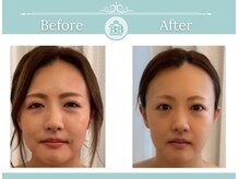 美人バスト 岡山店/【小顔コルギ症例】★