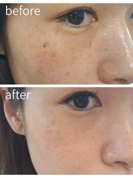 アースコアフュールボーテ ひたち野うしく店(EARTH coiffure beaute)/シミケアし放題◎光フェイシャル