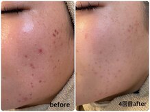 ユフラ(Juhla)/韓国式ハーブピーリング