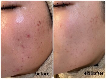 ユフラ(Juhla)/韓国式ハーブピーリング