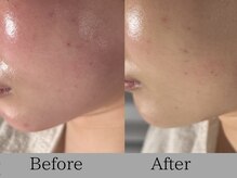 ルミライズ(lumirise)/〈７回目での効果期〉