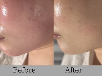 ルミライズ(lumirise)/〈７回目での効果期〉