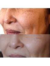 エトル(etole)/50代お客様症例写真