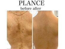 プランス 渋谷(PLANCE)/背中ケア！　渋谷