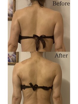 グランディール(GRANDIR)/【痩身】上半身コース8回