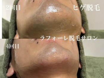 ラフォーレ 岸和田店/メンズヒゲ脱毛