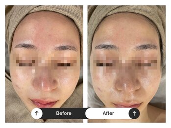 リジュ(Reje)/赤み&ニキビケア