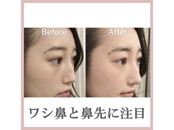 ラプリシュシュ 岡山店(Raplit)/ 隆鼻+輪郭矯正40分10回