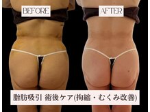 ココフィット(COCOFIT)の雰囲気（術後のむくみケアにはエンダモロジーが最適♪）