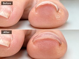 巻き爪矯正ビフォーアフター