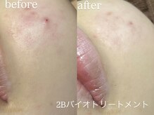 エーアール(ar)/ハーブピーリング/2Bバイオ