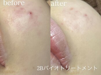 エーアール(ar)/ハーブピーリング/2Bバイオ