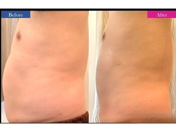 コリオ(KoRiO)/痩身5回目のお客様［狭山ヶ丘］