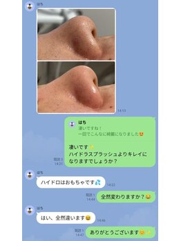 ケンビラク(Kenbiraku 健美楽)/ハイドラシャイン　小鼻B＆A感想