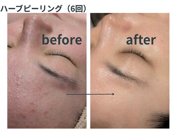 ミジタク 京都二条店(mijitaku)/ハーブピーリング6回目のお肌