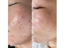 シャルムパリス(charme paris)の雰囲気（クリスティーナ認定サロンです#肌質改善#ニキビ）