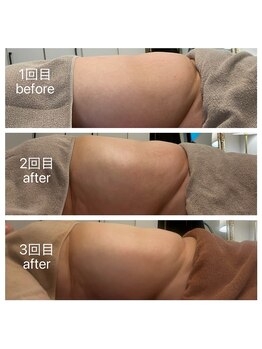 美温(mion)/インディバ×レッドショット