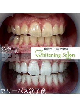 ホワイトニングサロン 札幌店の写真/【札幌・歯科提携サロン】高い実績口コミエリアTOPレベル!丁寧なカウンセリングでホワイトニング初心者◎