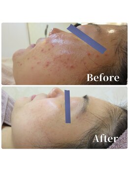 ザ フェース 京都御池店(THE FAITH)/お客様の肌変化