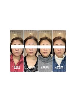 シエン ボーテ 馬車道 関内(Cyen BEAUTE)/3 回施術のビフォーアフター